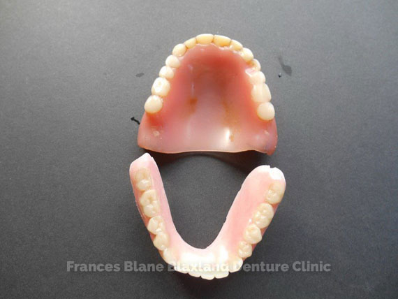 Some more top views of dentures that are worn out and need replacing